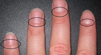 13 проблем со здоровьем, о которых предупреждают лунки на ногтях