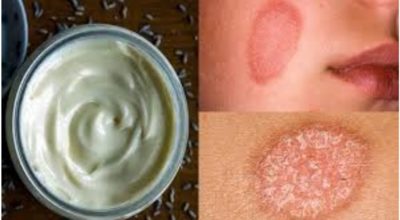 Древний рецепт лечебного крема быстро исцелит от кожных заболеваний, даже от экземы и псориаза