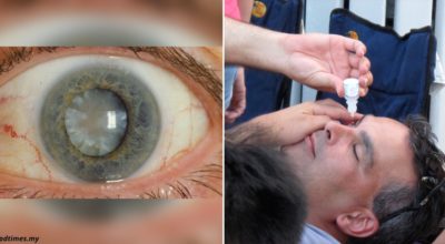 Появились глазные капли, которые могут растворить катаракту
